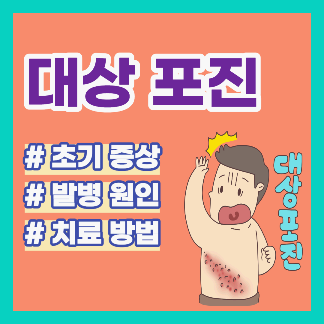 대상포진 초기증상,발병원인, 치료방법